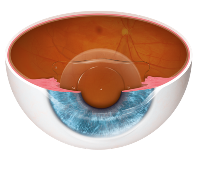 Phakic Lens (ICL) Implantation